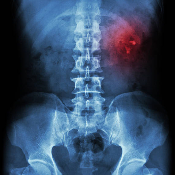 Kidney stone ( renal stone , renal calculi ) ( film x-ray KUB ( Kidney - Ureter - Bladder ) show left renal stone )