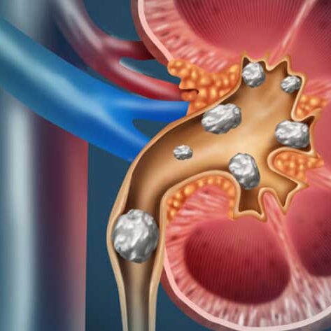 UCI-Kidney-Stone-Center-3-1